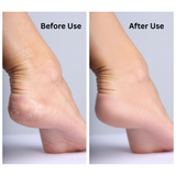 Electric Foot Buddy JF-888 – Callus Remover for Smooth Feet, Exfoliating Foot Grinder for Home & Travel, Universal Voltage