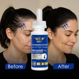 Pilot Minoxidil 5% Hair Regrowth Serum for Men & Women 3×60ml (3 Month Supply) – Extra Strength Topical Treatment for Thinning Hair (Vertex) – With Biotin, Ginseng & Herbal Extracts
